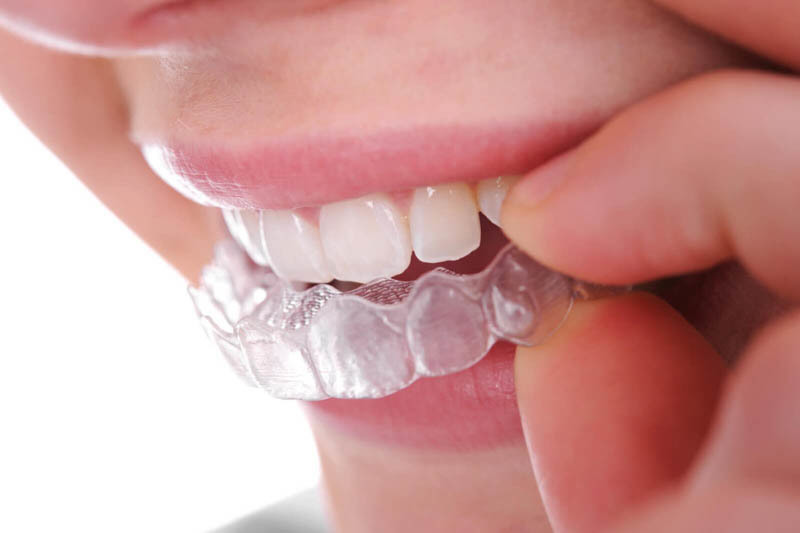 Tìm hiểu công nghệ niềng răng trong suốt là gì?