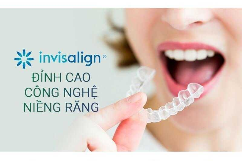 Phương pháp niềng răng Invisalign - đỉnh cao công nghệ niềng răng